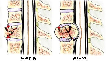 腰椎 圧迫 骨折 後遺症