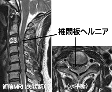 頚椎 ヘルニア 自然 治癒