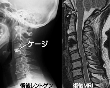 頚椎 ヘルニア 自然 治癒