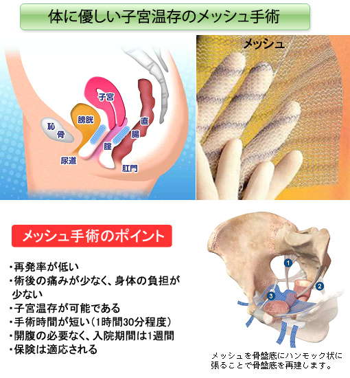ウロギネ）骨盤臓器脱の新たな治療～体に優しい子宮をとらない
