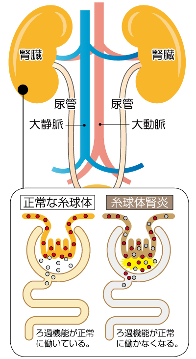腎移植）慢性腎臓病とそれを起こす病気について | 亀田グループ