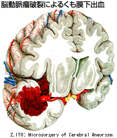 脳動脈瘤破裂によるくも膜下出血