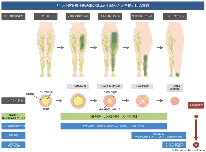 lymphedema12_01.jpg