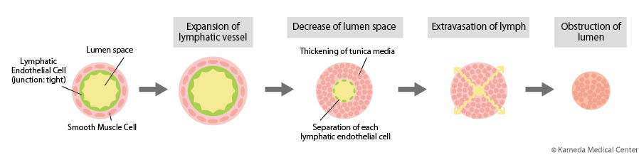 lymphedema3_1.jpg