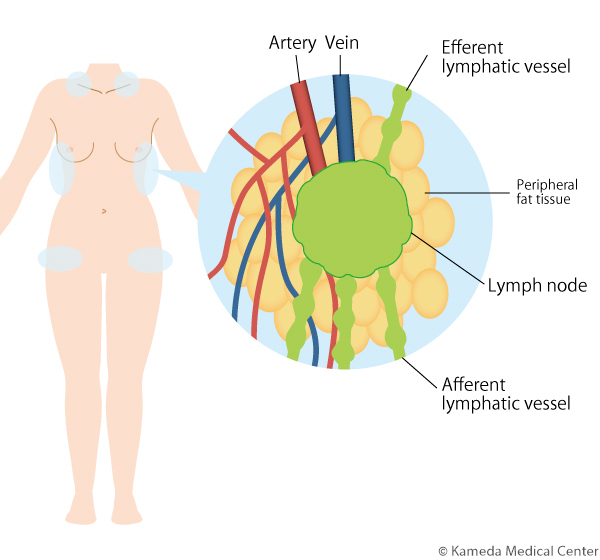 lymphedema8_1.jpg