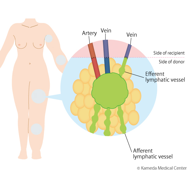 lymphedema8_2.jpg