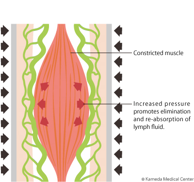 lymphedema9_1.jpg