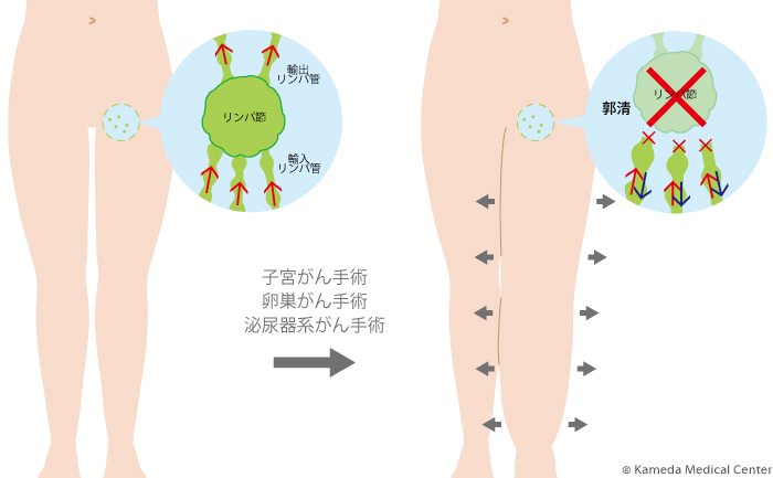 lymphedema2_2.jpg