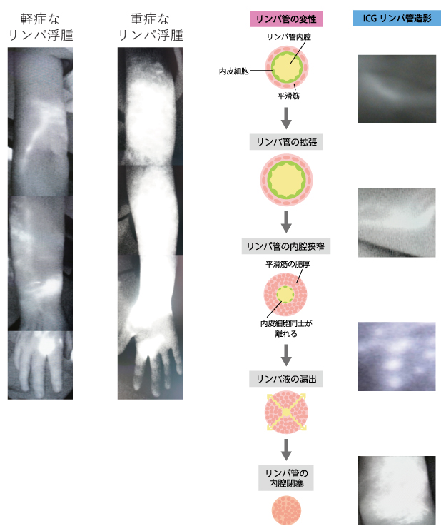 lymphedema5_01.jpg