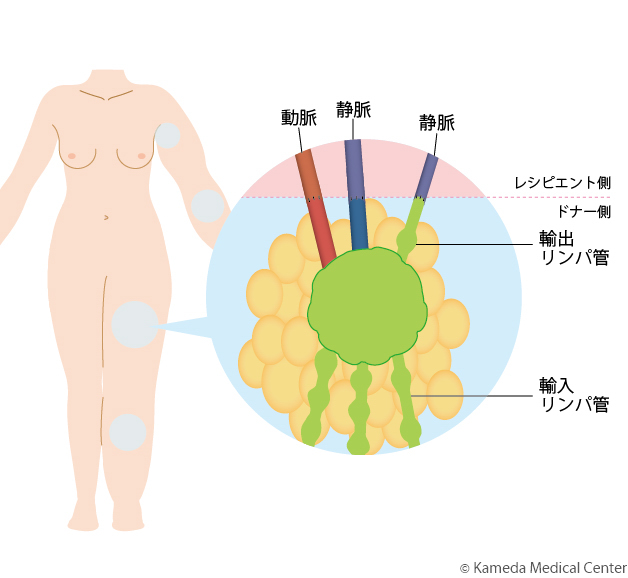 lymphedema8_02.jpg