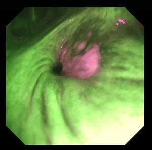気管支鏡による光診断：自家蛍光気管支鏡（Auto-Fluorescence Bronchoscopy: AFB）