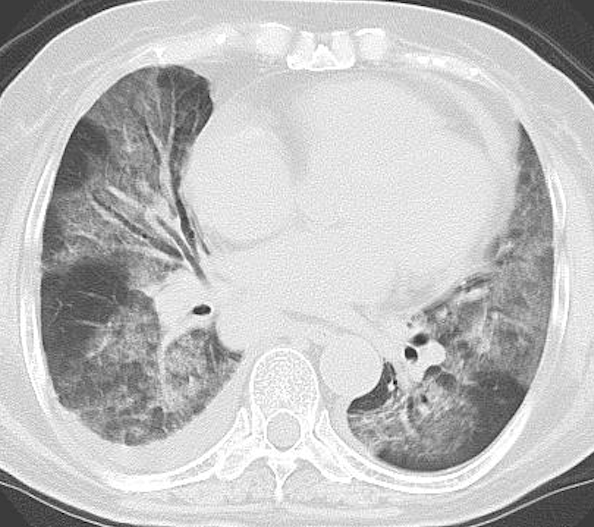 非HIVニューモシスチス肺炎の胸部CT所見