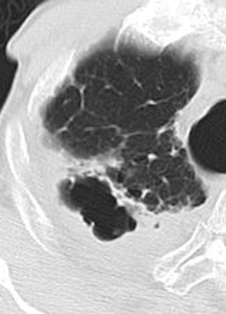 慢性進行性肺アスペルギルス症（CPPA：Chronic progressive pulmonary aspergillosis）