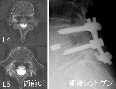 ちょっとためになる話10 腰椎すべり症 亀田メディカルセンター 亀田総合病院 脊椎脊髄外科