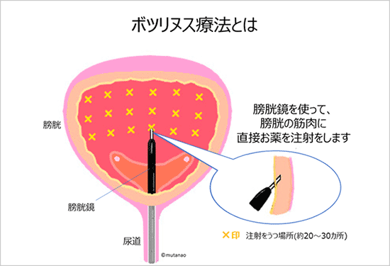 失禁効果をもたらす仙骨インプラント